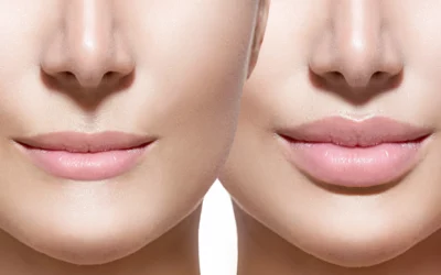 Is There Such Thing as Natural-Looking Lip Filler?
