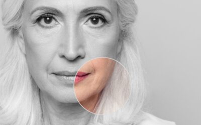 Can Jowls Be Fixed Without Surgery?