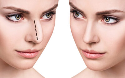 Can Non-Surgical Rhinoplasty Go Wrong?