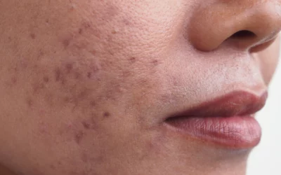 How to get rid of Hyperpigmentation?
