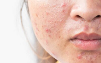 Are acne scars permanent? What treatment options are available