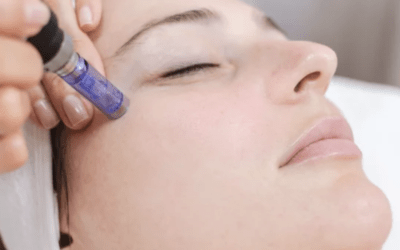 Microneedling your face in Esher, Surrey