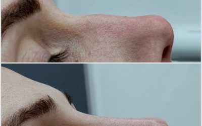 Nose Filler for a Crooked Nose