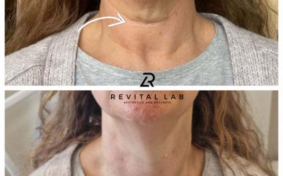 What is a Polynucleotide treatment and how can it benefit you