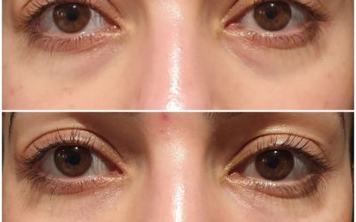 How is Tear Trough Filler Done?