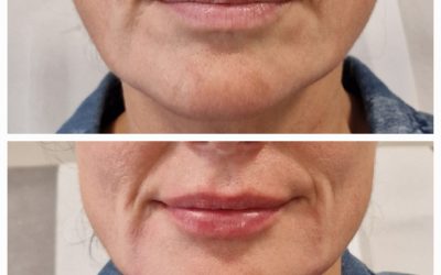 Understanding the Difference Between a Lip Flip and Lip Filler