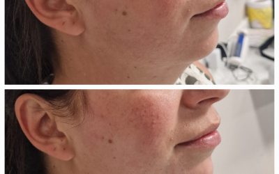 Combining Dermal Fillers and Polynucleotides