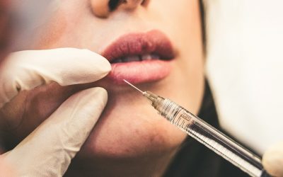 What is Radiesse Filler?