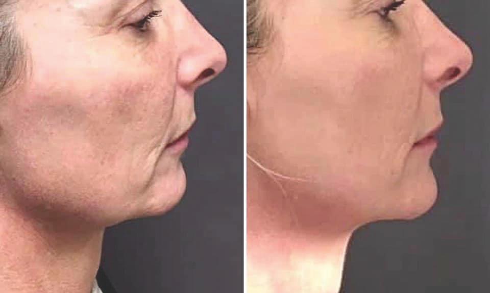 Non-Surgical Jawline Contouring