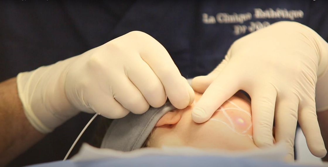 Non-Surgical Jawline Contouring