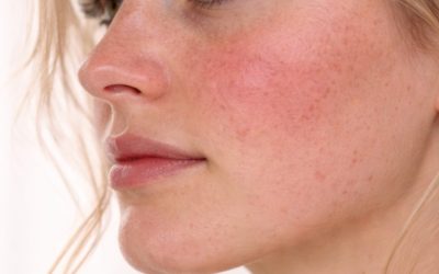 Rosacea: Symptoms, Triggers and the Treatments That Actually Work