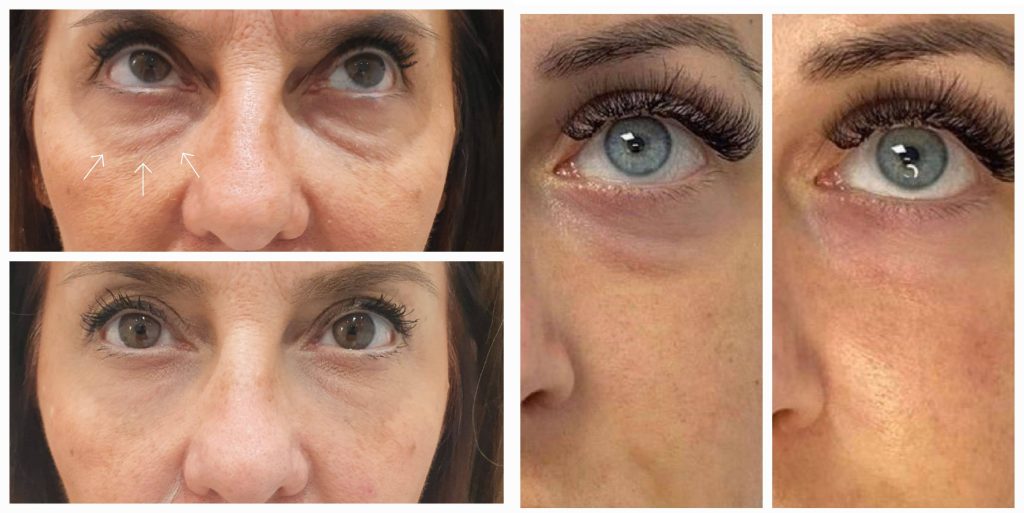 before and after under eye