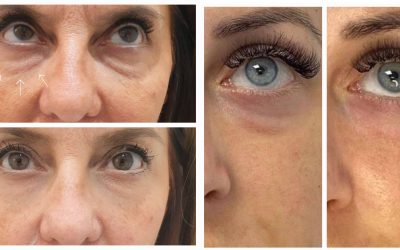 What Is the Best Treatment for Crepey Under Eye Skin?