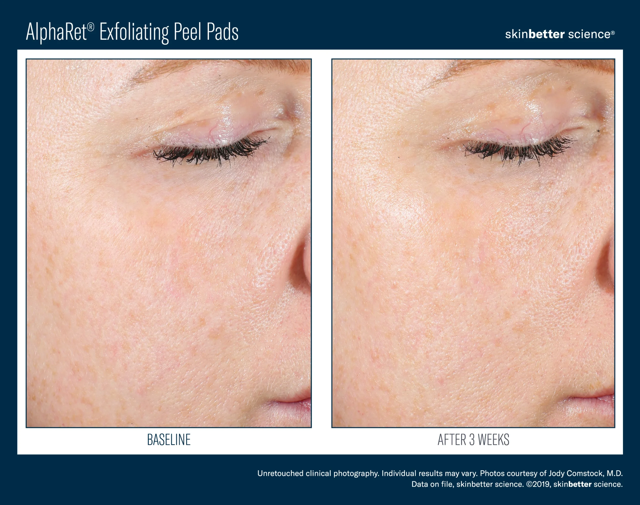 AlphaRet® Exfoliating Peel Pads (30 Pads) - Image 2